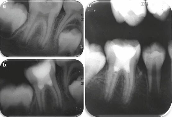 Пульпит у детей молочных зубов фото Pulp Therapy for the Young Permanent Dentition Pocket Dentistry