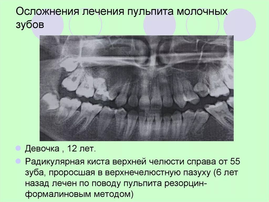 Пульпит у детей молочных зубов фото Новообразования костей лица у детей - презентация онлайн