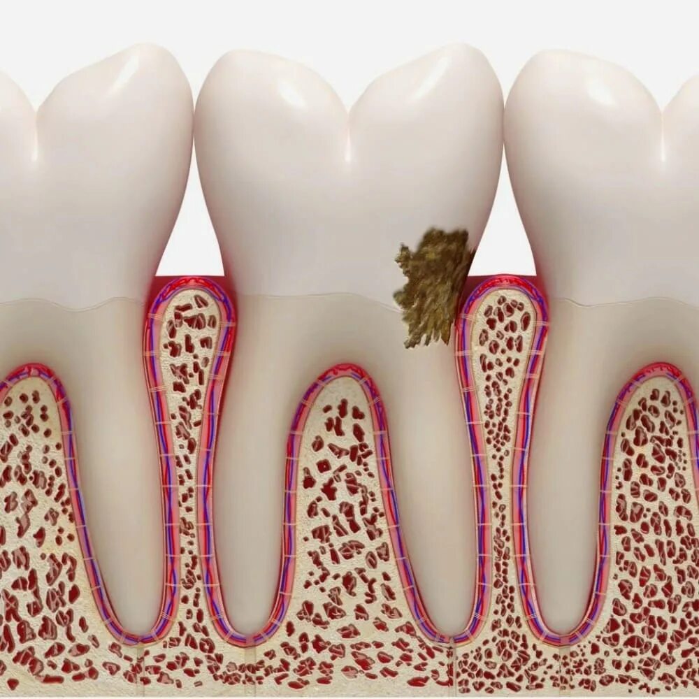 Пульпит зуба фото Лечение пришеечного кариеса в Москве по доступной цене Atlantis Dental