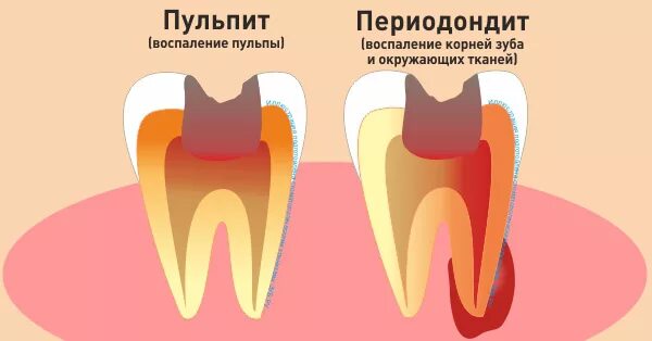 Пульпит зуба фото Лечение пульпита по доступной цене в Москве - Стоматология "Стомакс 1997" - офиц