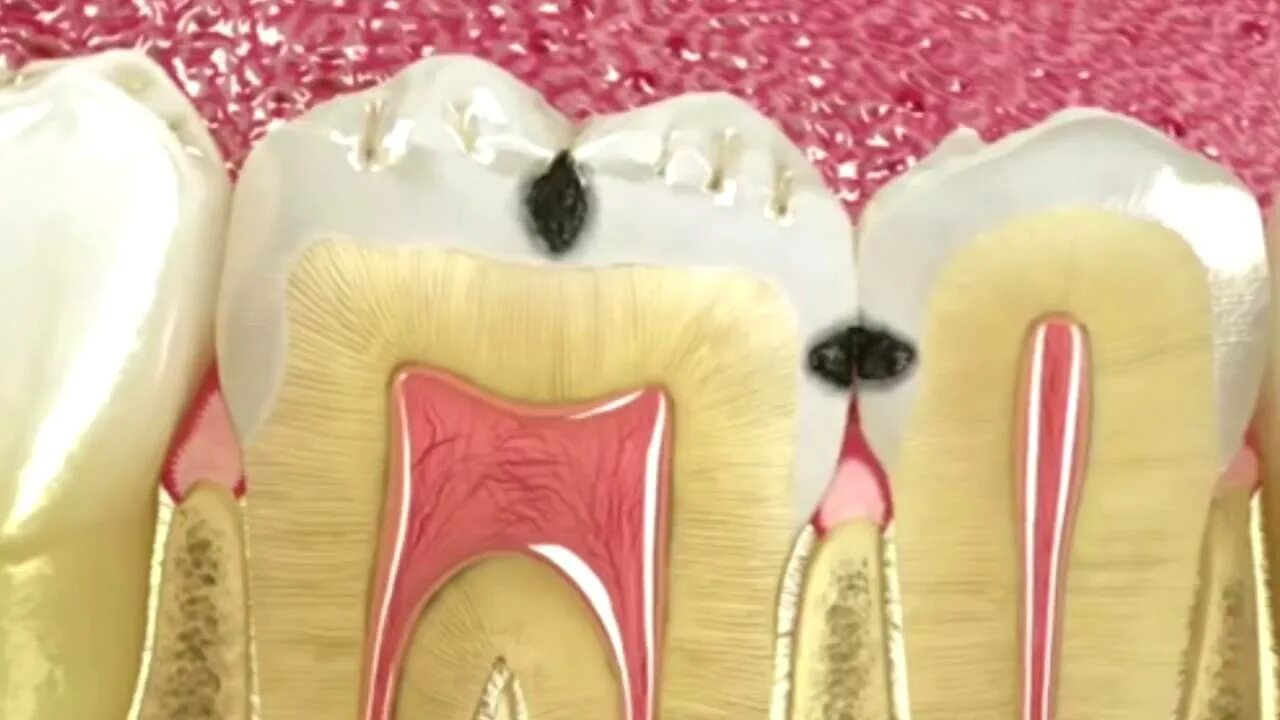 Пульпит зуба фото ENDODONCIA SANA RISA - YouTube