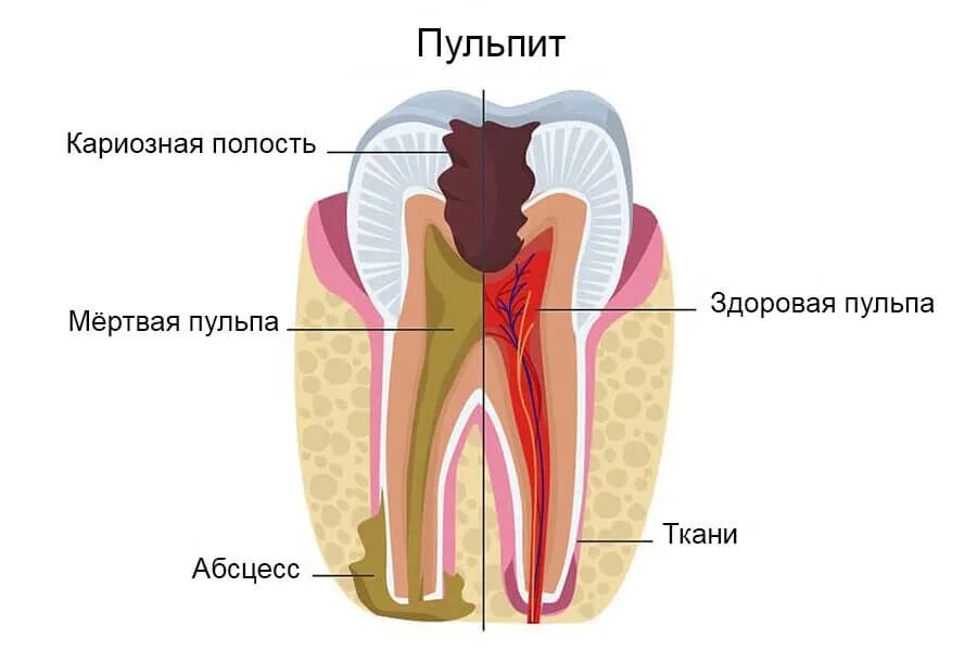 Пульпит зуба фото Лечение пульпита одноканального зуба недорого в Реутове и Новокосино - стоматоло