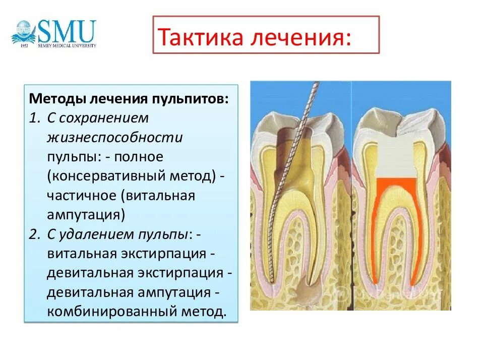 Пульпит зуба фото Методы лечения пульпы - найдено 76 картинок