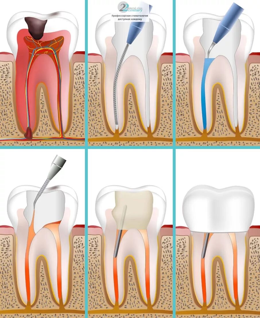 Пульпит зуба фото Перелечивание корневых каналов зуба, цены в Москве