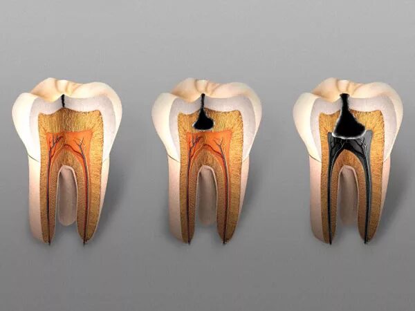 Пульпит зуба фото реальное Кариес зубов, лечение в Москве