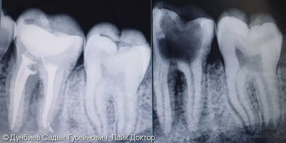 Пульпит зуба фото реальное Лечение хронического периодонтита зуб 3.6, 1 фото, Сургут