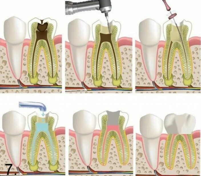 Пульпит зуба фото реальное Лечения пульпита зуба по доступным ценам в Новосибирске