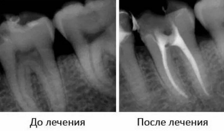 Пульпит зуба как выглядит снаружи Стоматология, dental polyclinic, Michurinsk, Kirsanovskaya ulitsa, 2Б - Yandex M