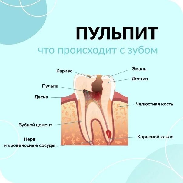 Пульпит зуба как выглядит снаружи Пульпит. Простыми словами пульпит - это воспаление в нерве зуба, а правильнее в 