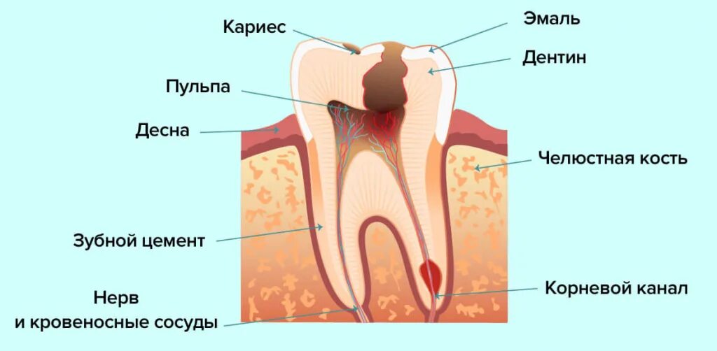 Пульпит зуба как выглядит снаружи Лечение пульпита по низким ценам. Симптомы и методы лечения НоваДент