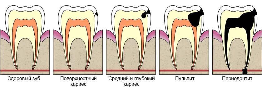 Пульпит зуба как выглядит снаружи Лечение зуба в Москве под ключ, недорогие цены от ДантистоФФ