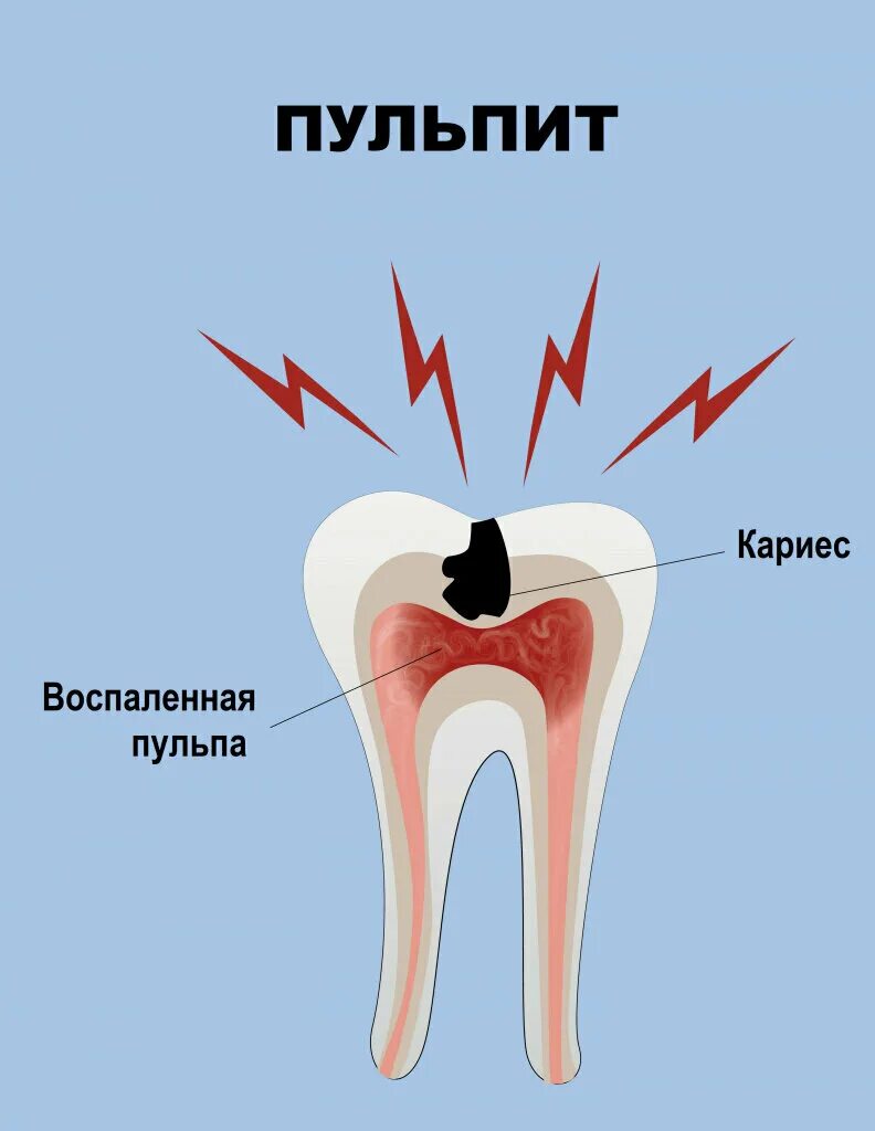 Пульпит зуба симптомы фото Happy Clinic, dental clinic, Краснодар, проспект Константина Образцова, 6/1 - Ya