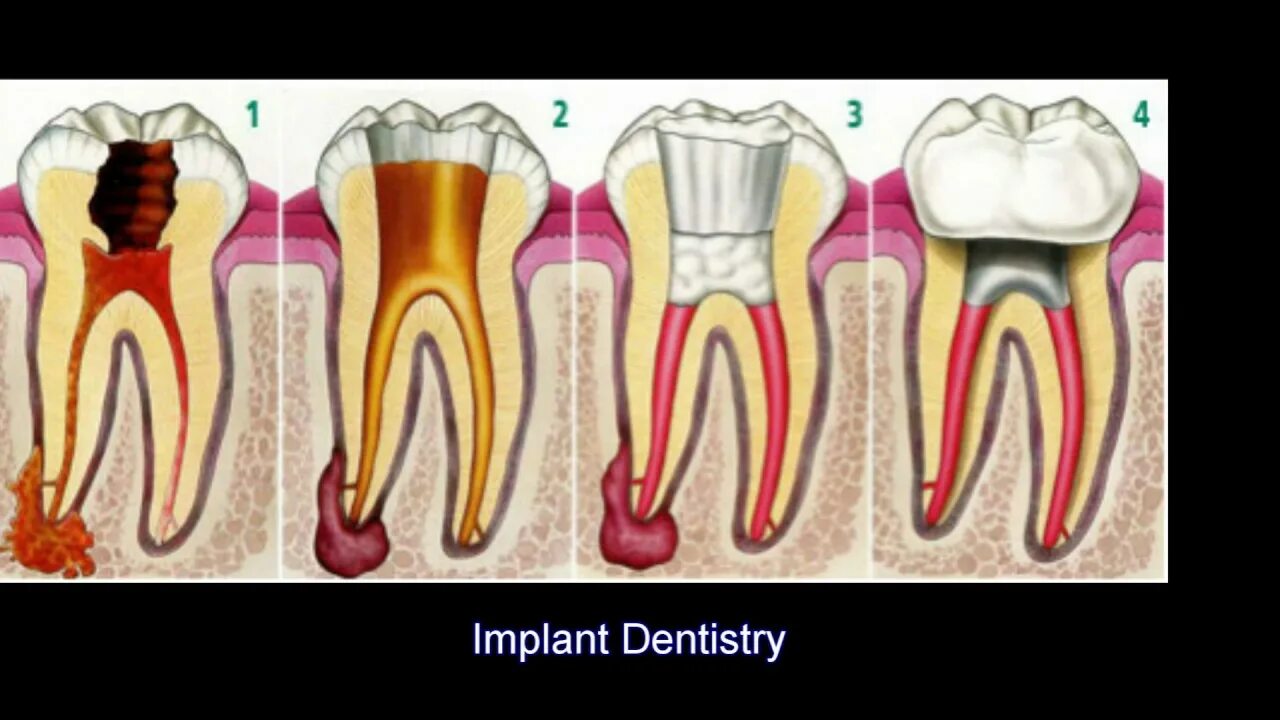 Пульпит зуба симптомы фото What to do When You Have a Tooth Ache - YouTube