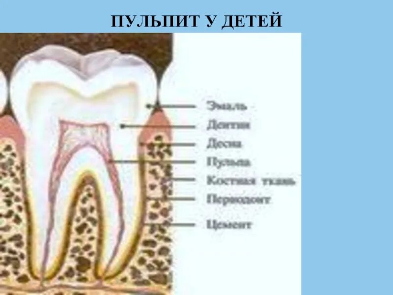 Пульпит зуба у детей фото Особенности клинического течения , даигностики и лечения пульпитов у детей