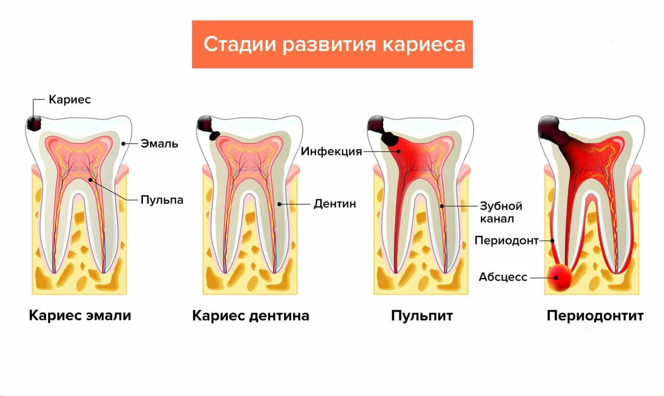 Пульпит зуба у детей как выглядит Смоленская областная клиническая стоматологическая поликлиника :: Отделения :: Т