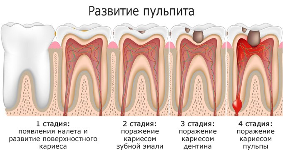 Пульпит зуба у детей как выглядит Лечение пульпита зубов в СПБ - Цена, отзывы в стоматологии ARS Dental