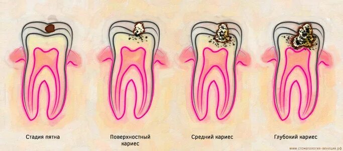 Пульпит зуба у детей как выглядит Цены "Стоматологическая клиника Бонастом" в Красноярске - Яндекс Карты