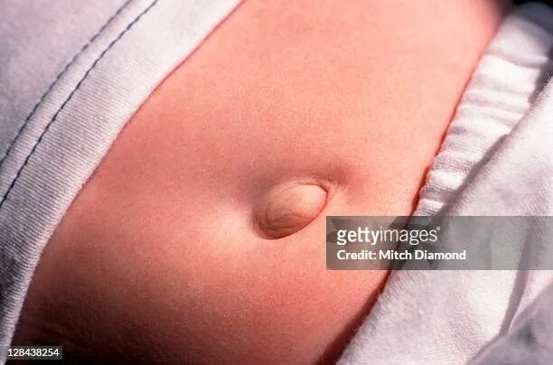 Пупковая грыжа симптомы фото Belly Button High-Res Stock Photo - Getty Images