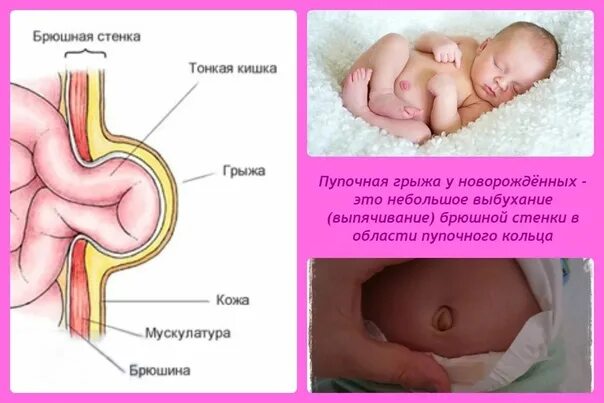 Пупочная грыжа симптомы фото у мужчин Hernia - protrusion of internal organs from the cavity in which they are located