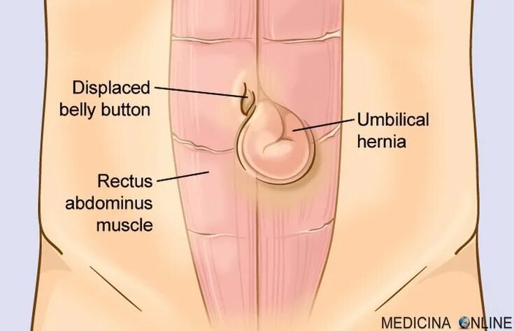 Пупочная грыжа симптомы фото у мужчин Pin on medical sciences - medicina