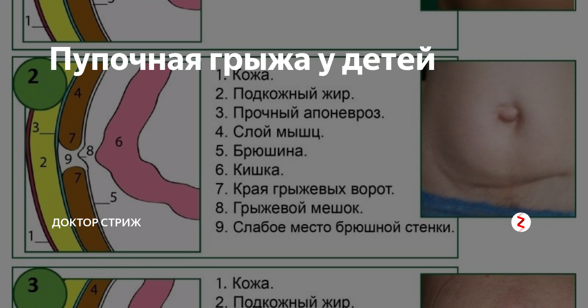 Пупочная грыжа симптомы фото у мужчин Пупочная грыжа у детей Доктор Стриж Дзен