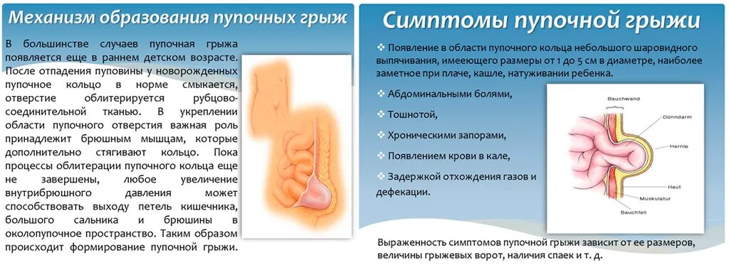 Пупочная грыжа симптомы у взрослых фото Пупочная грыжа у взрослых: причины, симптомы, лечение операцией