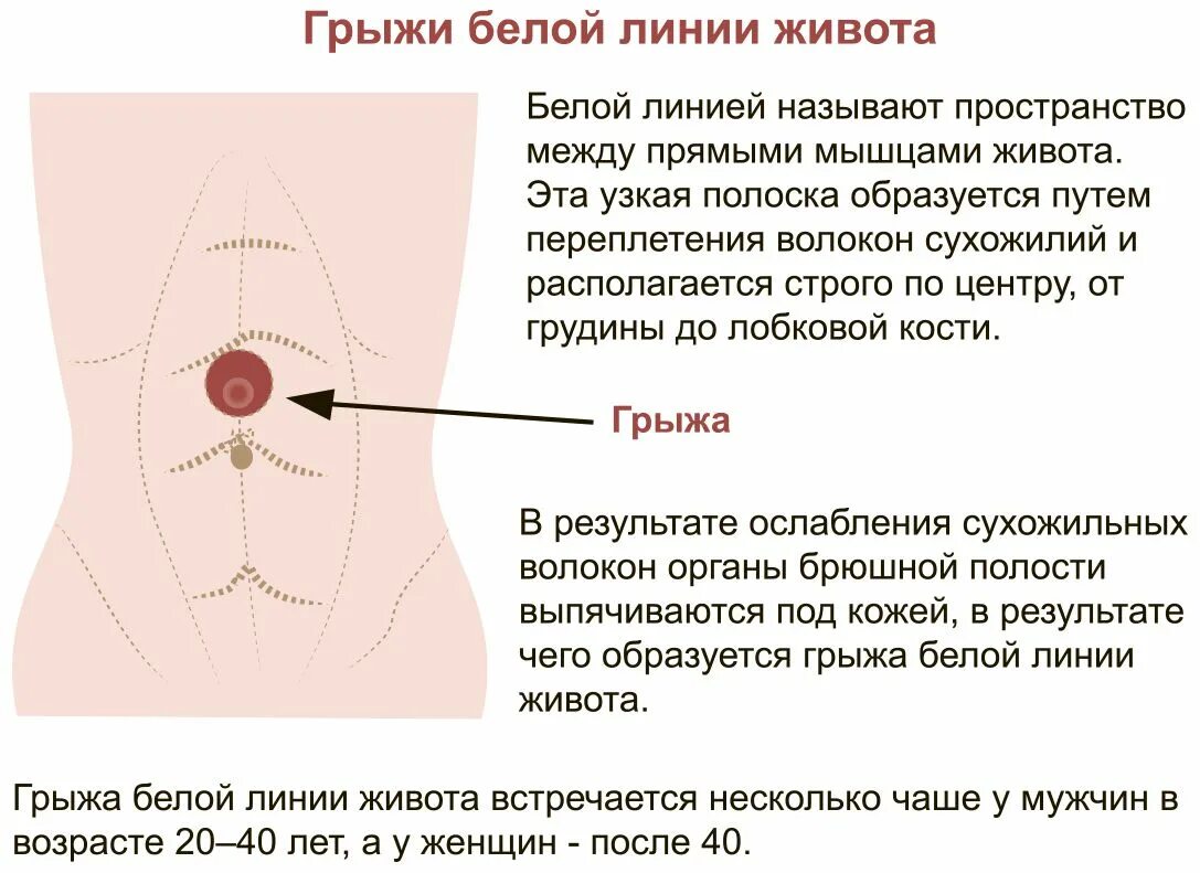 Пупочная грыжа симптомы у женщин фото Грыжа живота: причины, симптомы, диагностика и лечение в статье хирурга Мнояна А