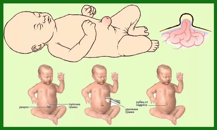 Пупочная грыжа у новорожденного фото как выглядит Причина и лечение пупочной грыжи у новорожденных детей