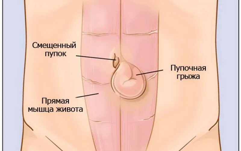 Пупочная грыжа у взрослых фото как выглядит Faraway - Научные работы сотрудников МЗ Forum - Arizona RolePlay