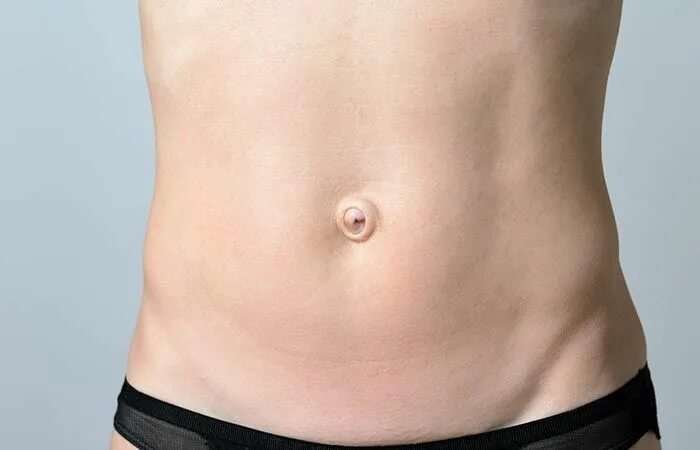 Пупочная грыжа у взрослых фото как выглядит Are You An Innie Or An Outie Belly Button? Here’s What It Means! Belly button, B