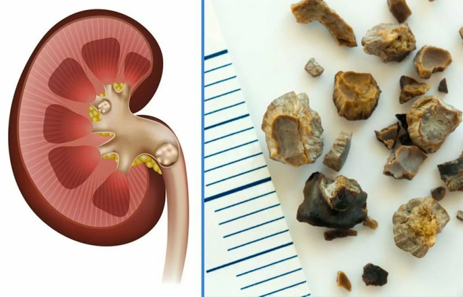 Пупочные камни как выглядят Каким размером камень может выйти из почки