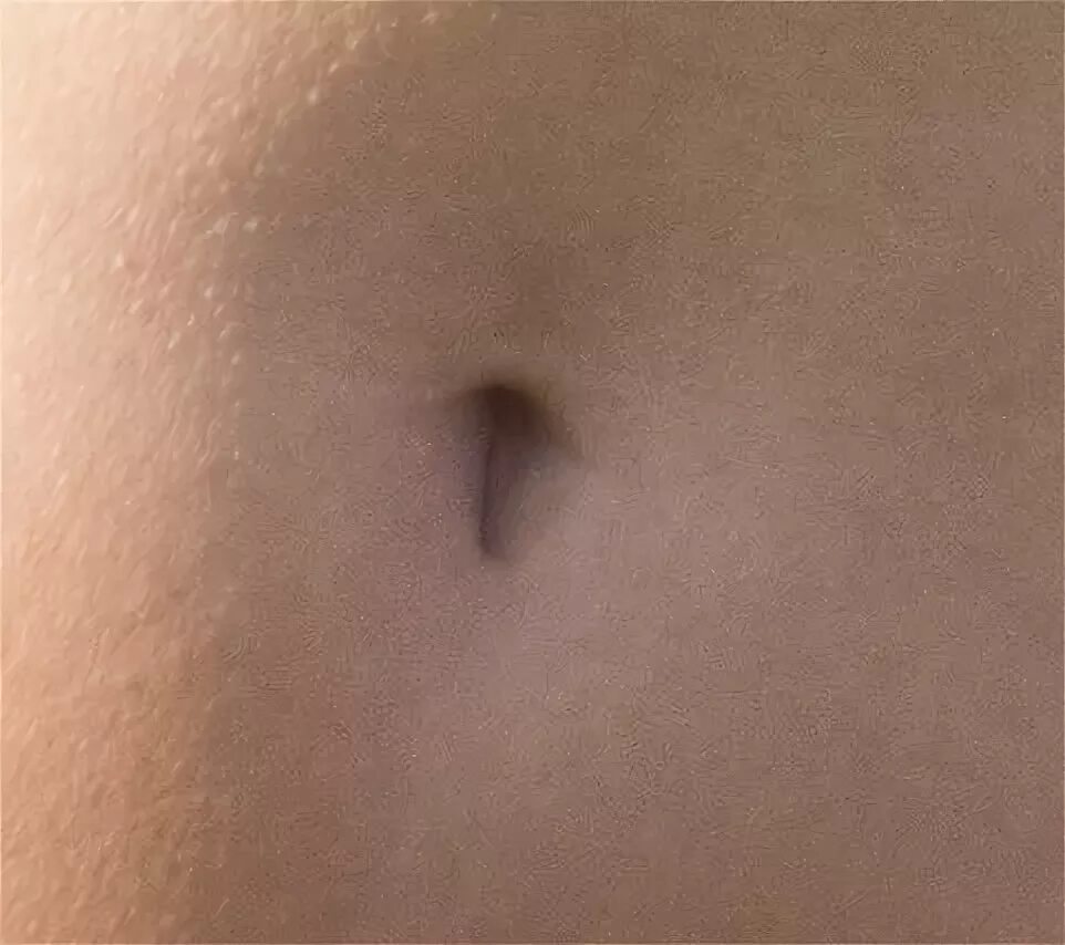 Пупочный камень фото как выглядит Файл:T-shaped navel.jpg - Википедия