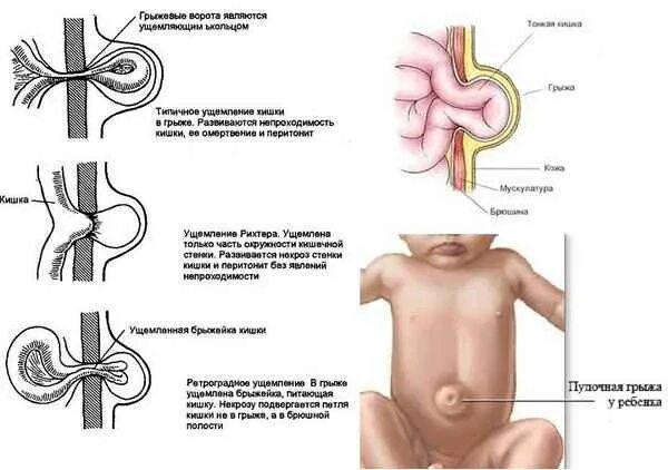 Пуповая грыжа симптомы у взрослого женщины фото Способы лечения пупочной грыжи у ребёнка, признаки Русский спорт - научная база
