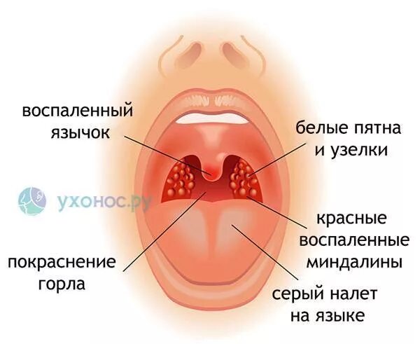 Пупырышки в горле у ребенка фото У грудничка ангина форум: у ребенка ангина - 58 ответов на форуме Woman.ru - Тал