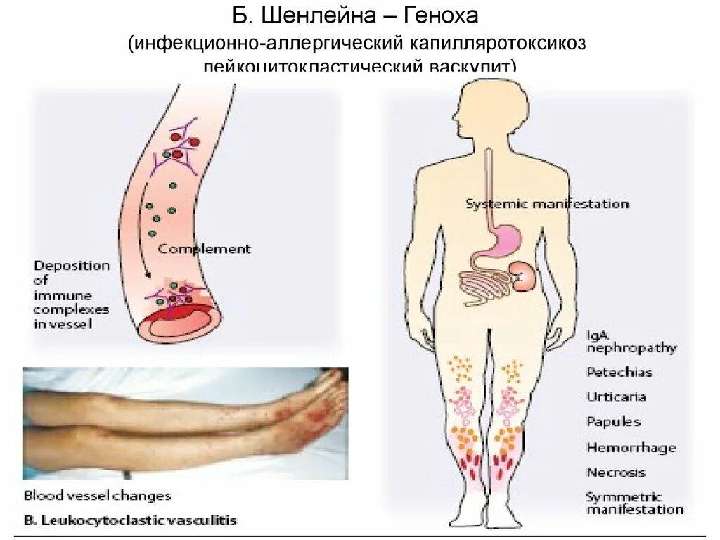 Пурпура симптомы фото Васкулит клинические рекомендации