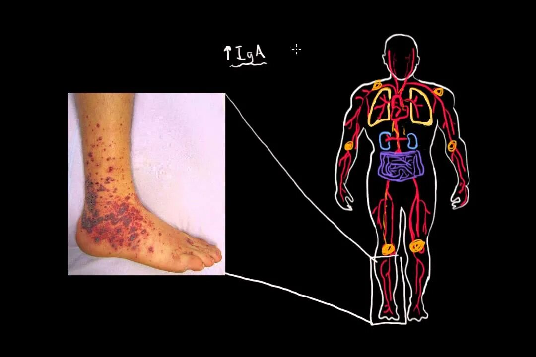 Blood Clot After Bruised Leg Hotsell www.beztabaka.by