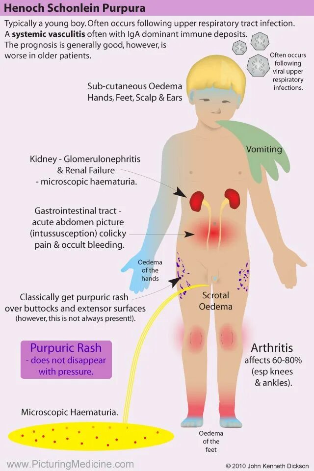 Пурпура симптомы фото Pin on 4. Hematology