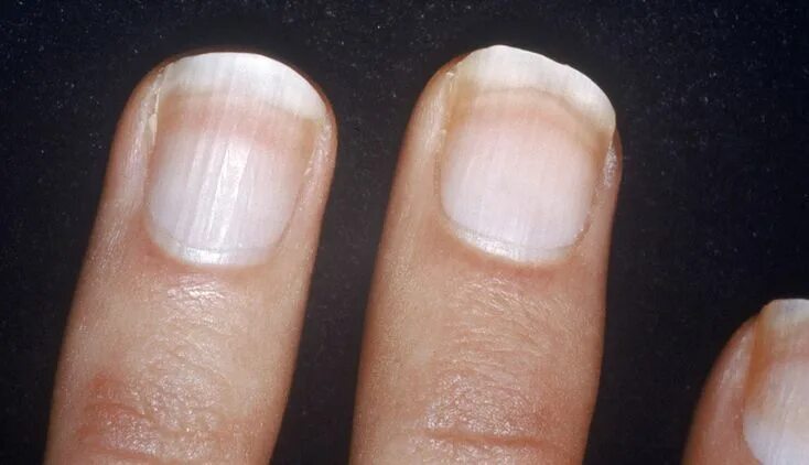 Пустоты на ногтях фото What Your Nails Say About Your Health White nails, Fingernail health signs, Nail