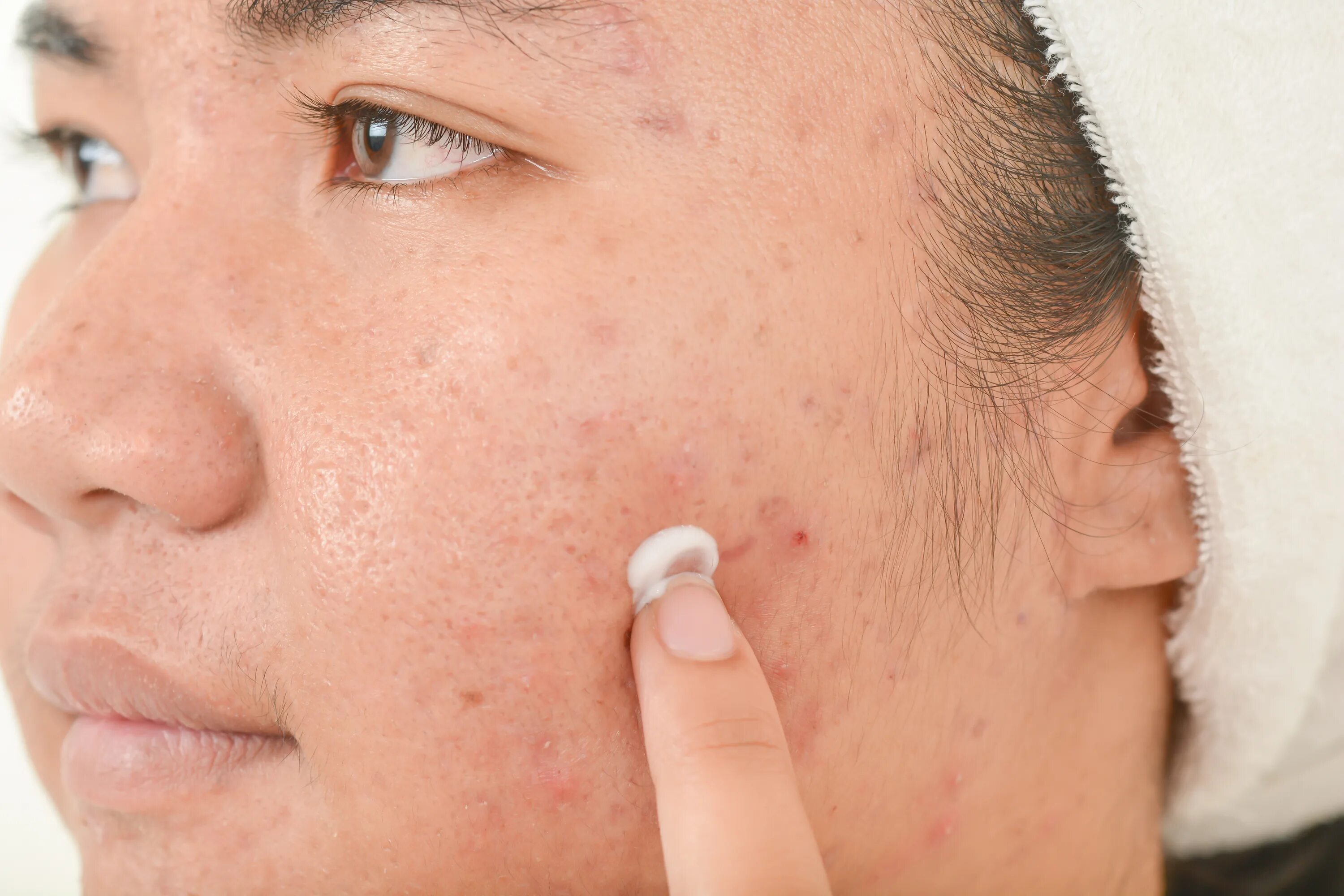 Пустулы на лице фото Skincare brands are accused of making fake claims they can cure ACNE as a watchd