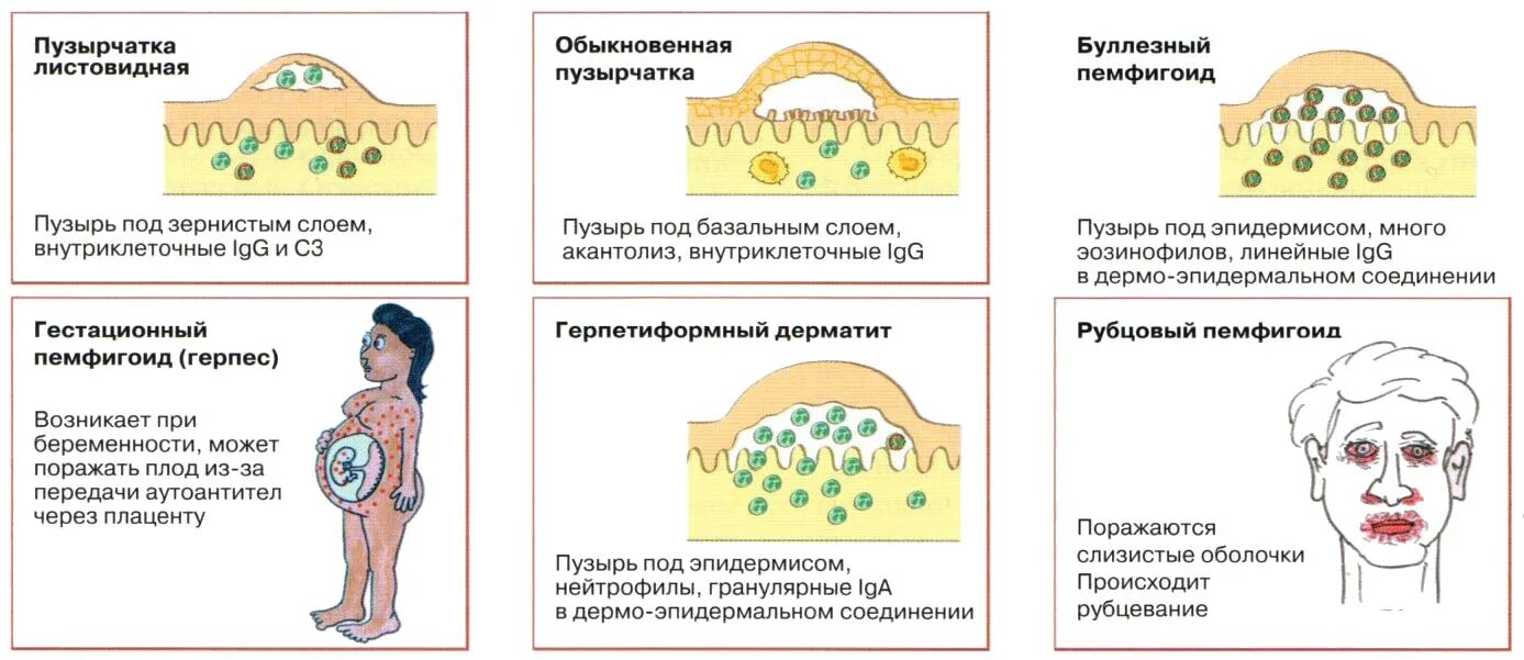 Пузырчатка фото симптомы Farmf литература для фармацевтов : Лекции " Пузырчатка (пемфигус). Классификация