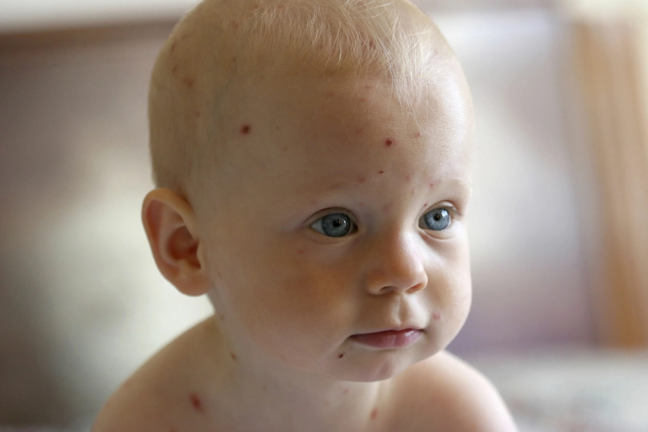 Пузырчатка у детей симптомы фото More than half of chickenpox diagnoses are wrong, study finds Ars Technica