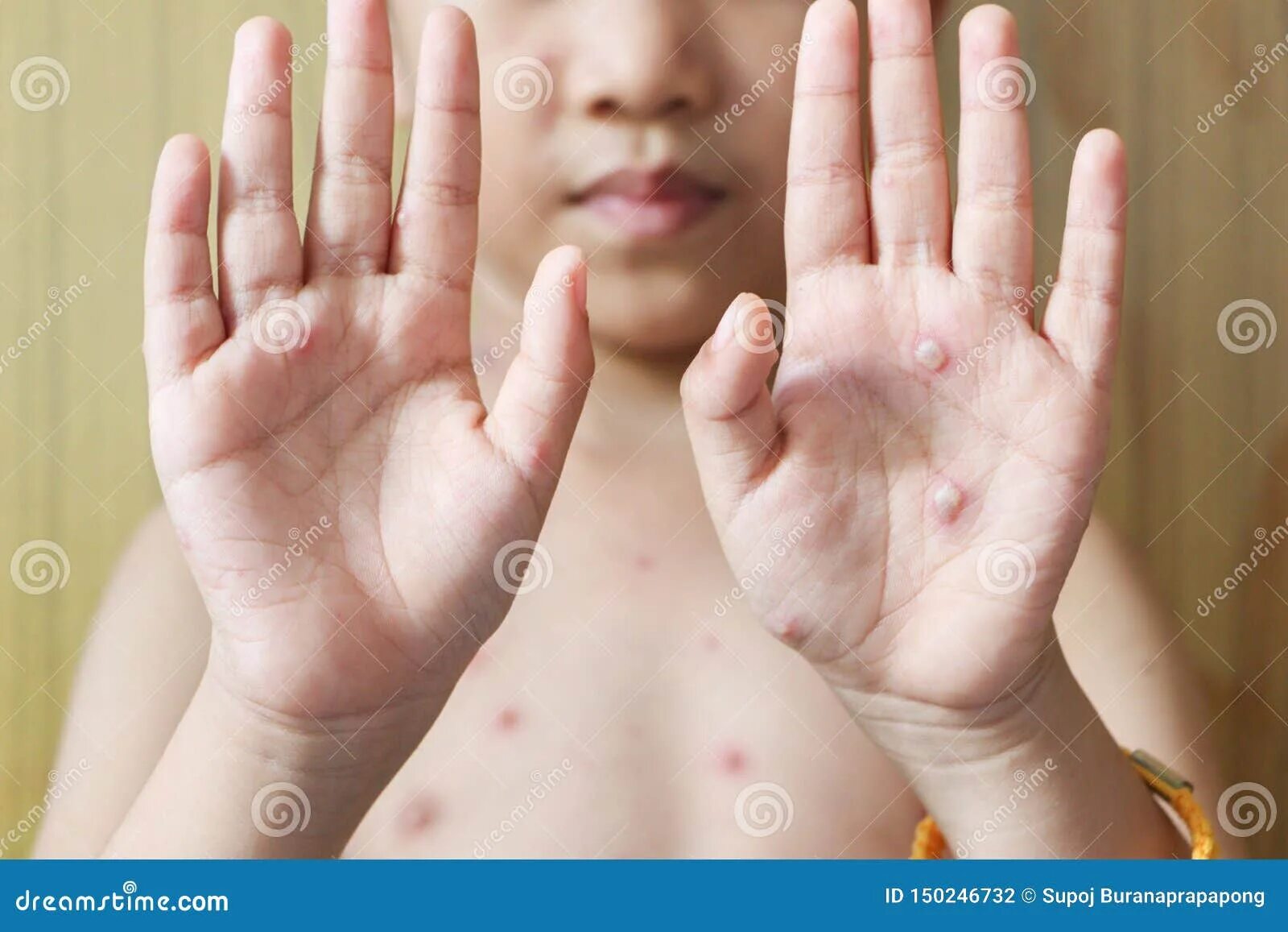 Пузырчатка у детей симптомы фото Chicken Pox Rash on Young Boy Body.Chickenpox is an Infection Caused by the Vari