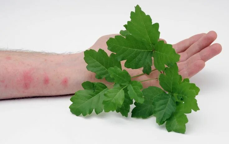 Пузырчатый дерматит на ногах фото If you spend time outdoors, chances are you have been bothered by poison ivy, po