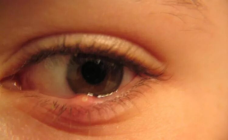 Пузырьки на глазу фото Have a Lump on Your Eye? Here's What It Could Mean TipHero