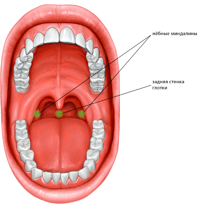 Пузырьки на задней стенке горла фото Лечение тонзиллофарингита. Заболевание горла