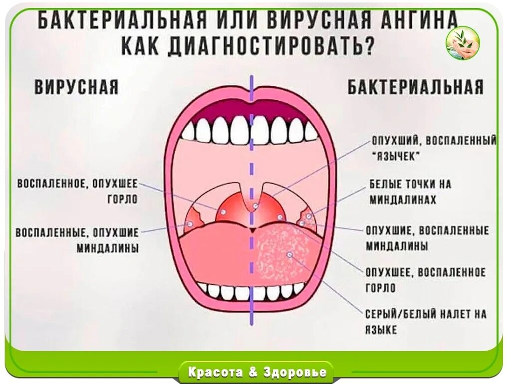 Пузырьки в горле у взрослого фото Ангина сколько дней держится температура у детей - найдено 82 картинок