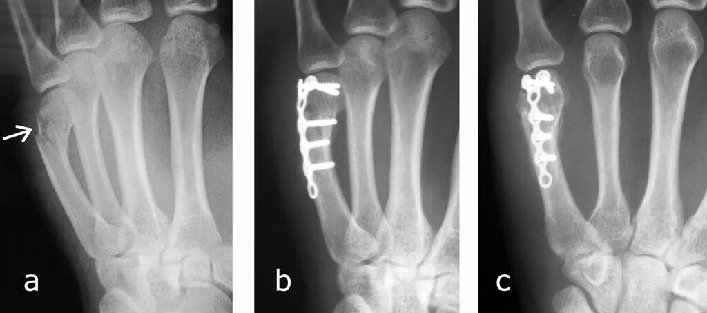 Пястная кость руки фото Операция пястной кости
