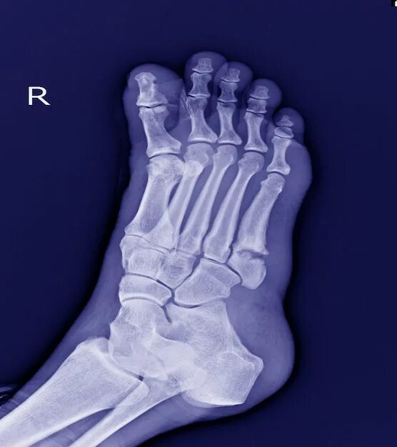 Пятая кость стопы фото Premium Photo X-ray foot : 5th Metatarsal Base Fracture small bone.Fracture foot