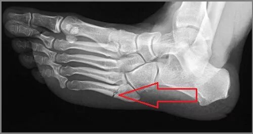 Пятая кость стопы фото Перелом 5-й плюсневой кости