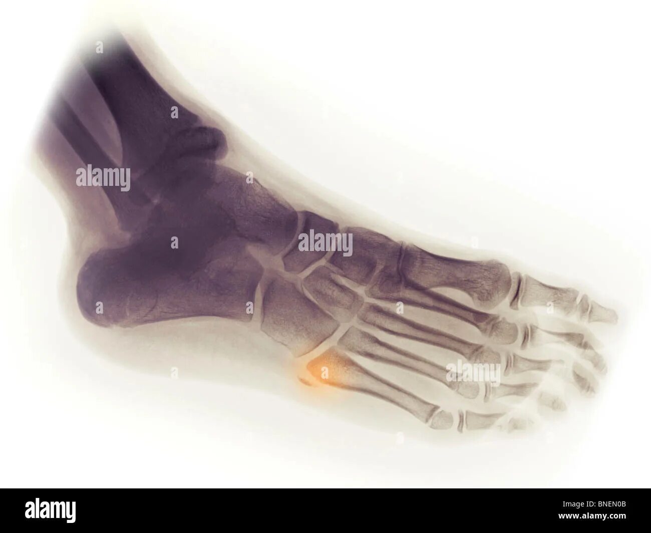 Пятая кость стопы перелом фото Bone fracture xray Cut Out Stock Images & Pictures - Alamy